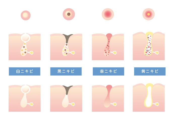 ニキビの進行イメージ