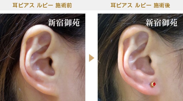 耳ピアス施術例5