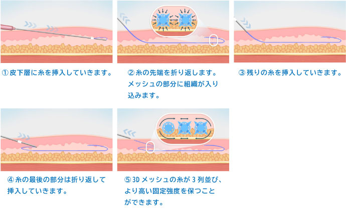 切らないリフトアップ施術